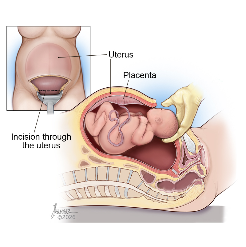 Medical Illustration of a Cesarean Section