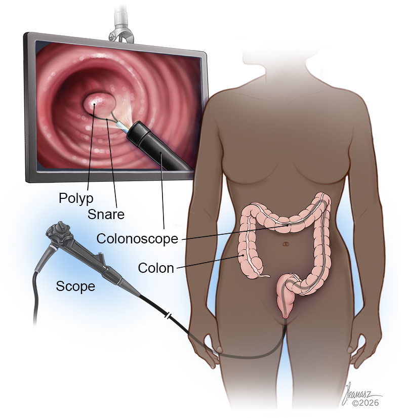 Medical Illustration of a Colonoscopy