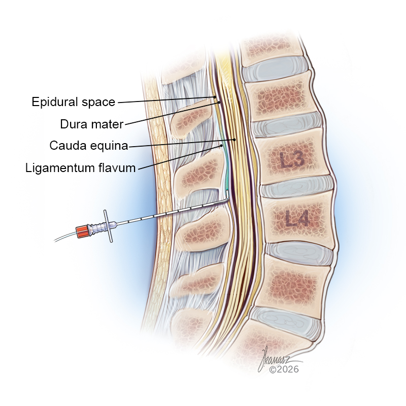 Medical Illustration of an Epidural