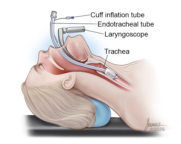 Medical Illustration of an Intubation