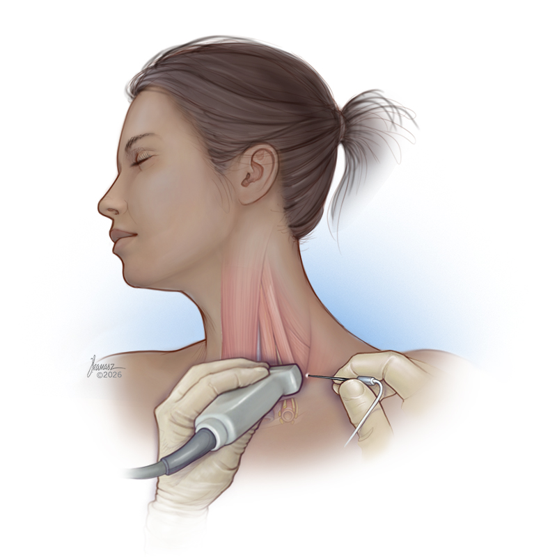 Medical Illustration of a Regional Nerve Block