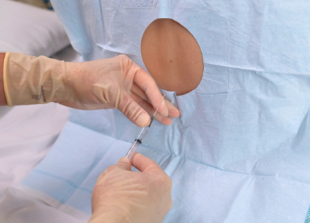 Epidural during pregnancy